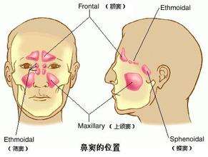 西安鼻窦炎病因,西安中大耳鼻喉医院
